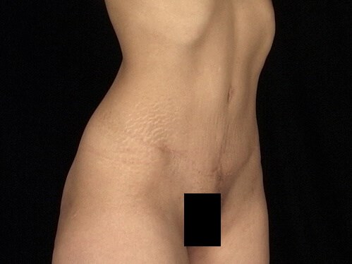 widened scar treatment