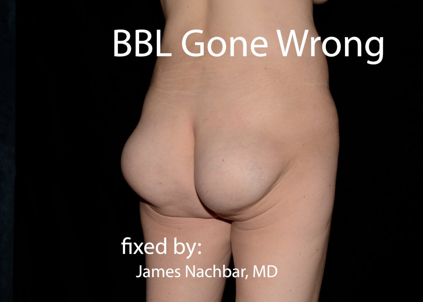 Fixing a Brazilian Butt Lift (BBL) Gone Wrong