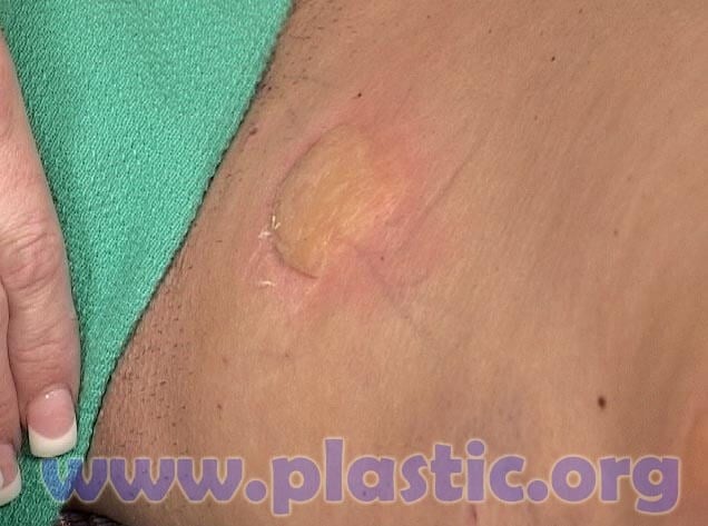 Friction Burn On Inner Thigh - Temu