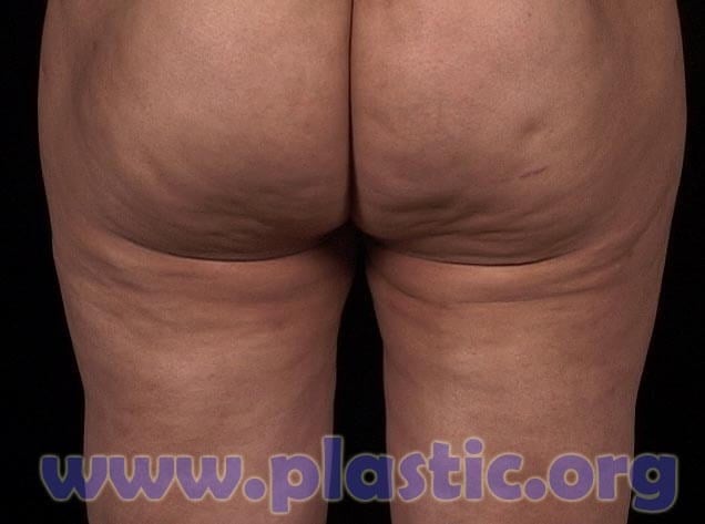 The Truth About Liposuction - Dumb vs. Smart LipoLiposuction