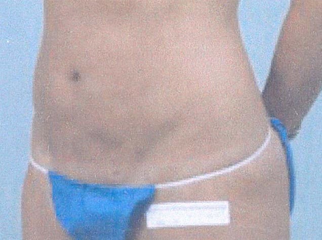 Laser Liposuction Touch Ups